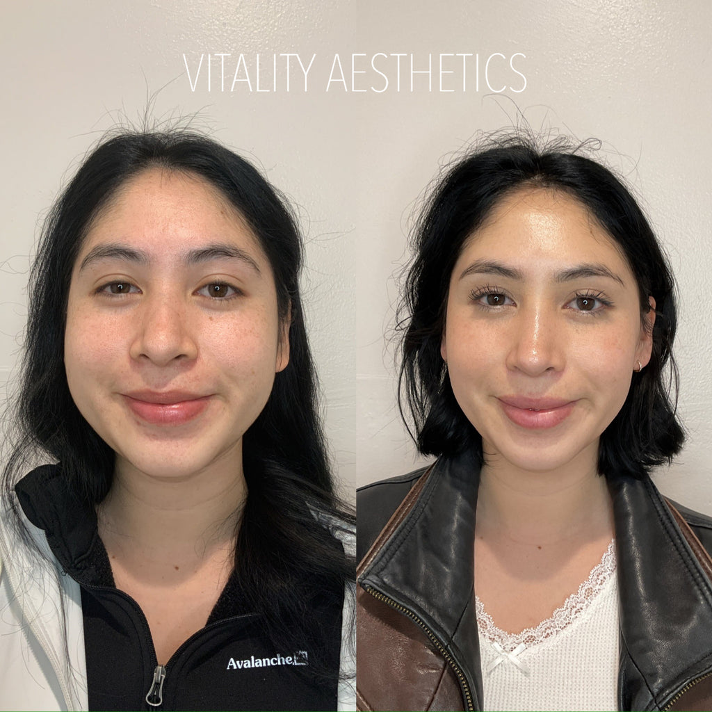 What to expect from jaw Botox! | Vitality Aesthetics