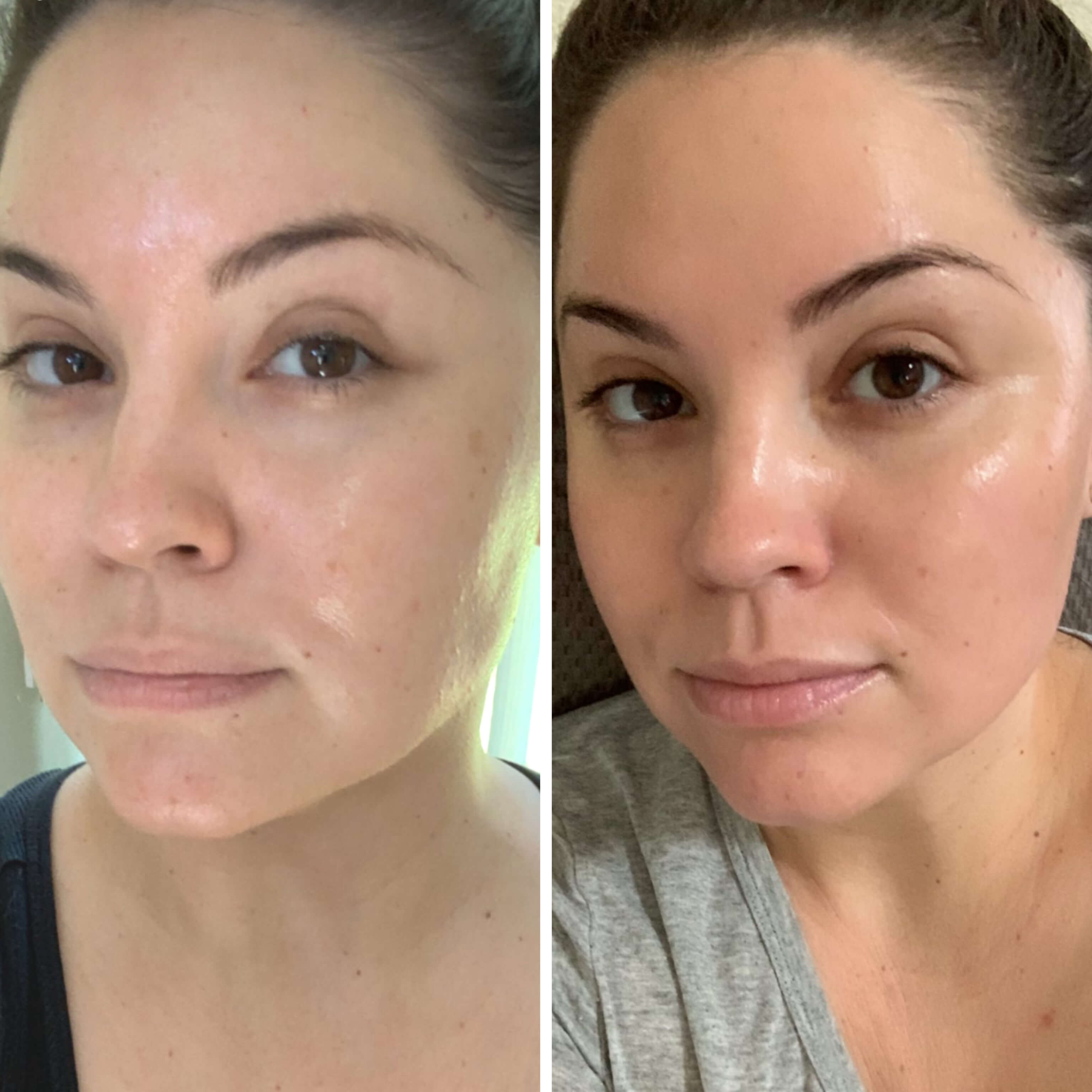 How chemical peels work