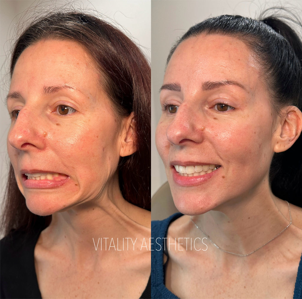 The Nefertiti Neck Lift: Rejuvenate Your Neck with Botox or Dysport