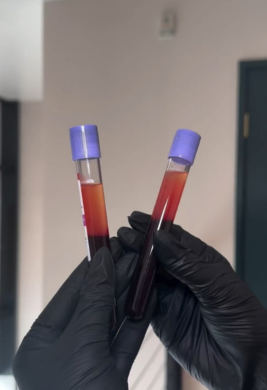 PRP vs. PRF: What is the difference?