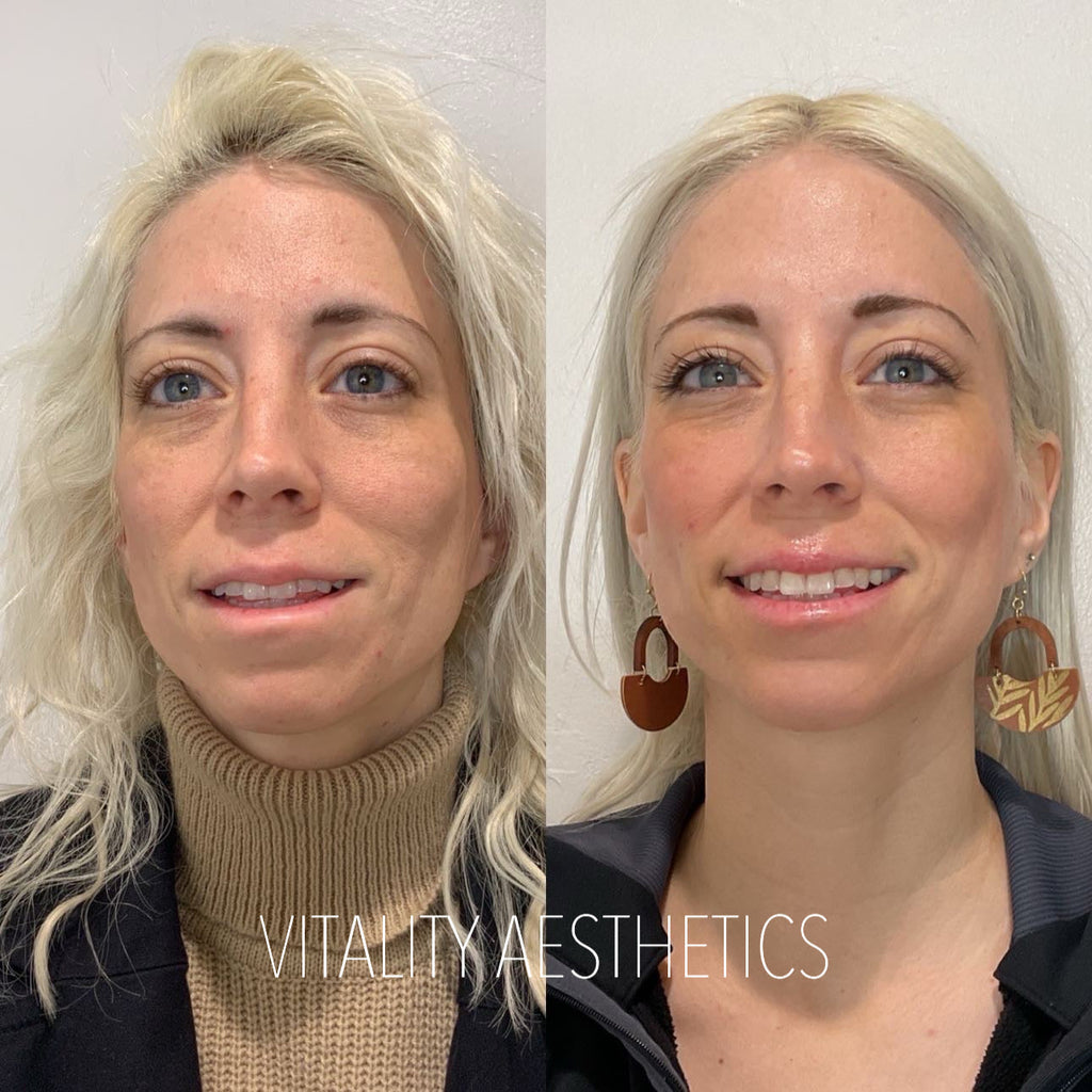 Ozempic Face: What It Is—and How We Treat It at Vitality Aesthetics