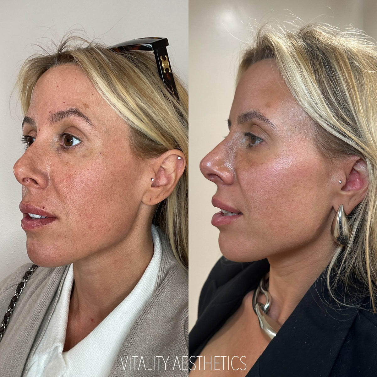 Skinvive: the skin booster you never knew you needed! | Vitality Aesthetics