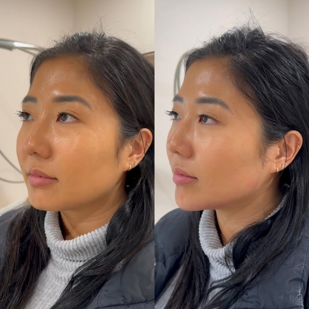 Is is possible to get more symmetrical with facial fillers?